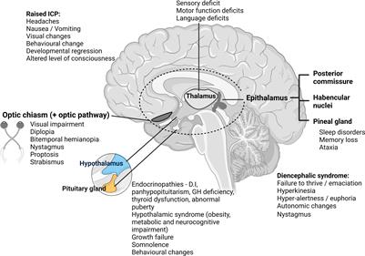 Novel therapeutic approaches for pediatric diencephalic tumors: improving functional outcomes